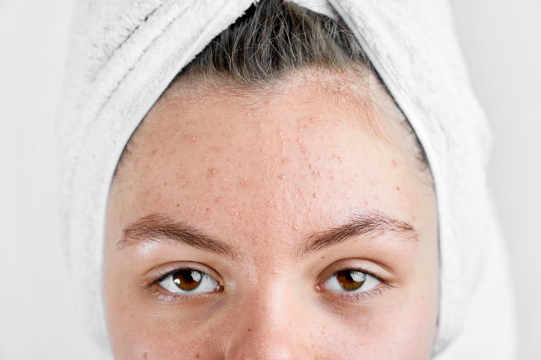 5 Acne Myths That Keep You From Achieving Clearer Skin